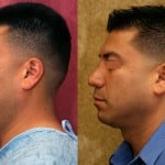 Male Rhinoplasty Before & After Patient #6418