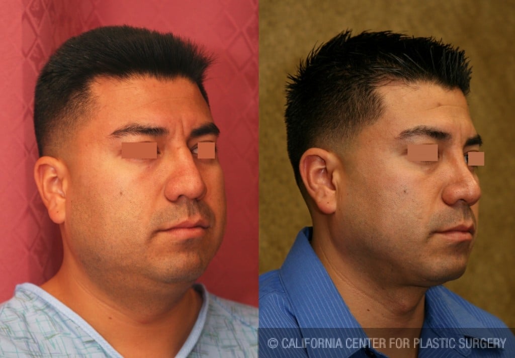 Male Rhinoplasty Before & After Patient #6418