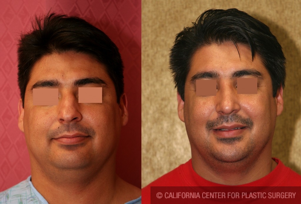 Male Rhinoplasty Before & After Patient #6413