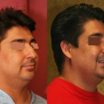 Male Rhinoplasty Before & After Patient #6413