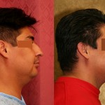 Male Rhinoplasty Before & After Patient #6413