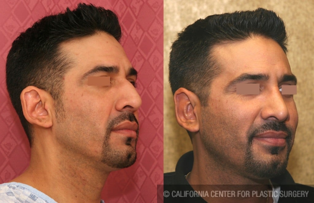 Male Rhinoplasty Before & After Patient #6431