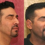 Male Rhinoplasty Before & After Patient #6431