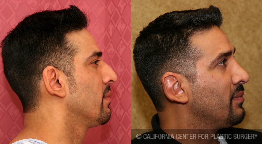 Male Rhinoplasty Before & After Patient #6431