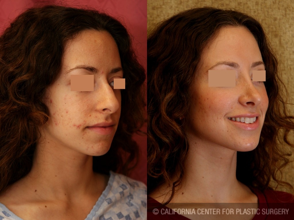 Rhinoplasty - Caucasian Before & After Patient #6243