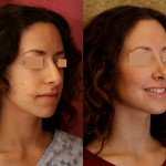 Rhinoplasty - Caucasian Before & After Patient #6243