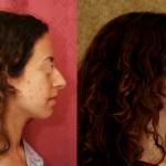 Rhinoplasty - Caucasian Before & After Patient #6243