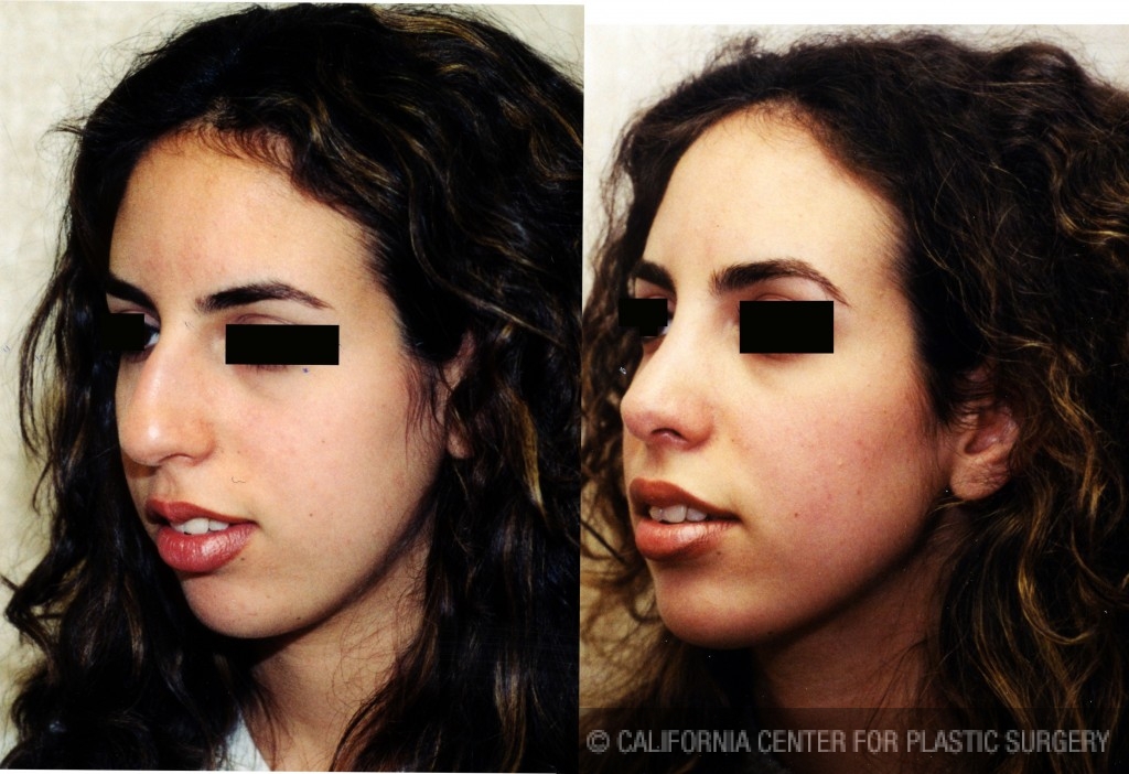 Patient 6325 Middle Eastern Rhinoplasty Before and After