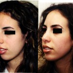 Rhinoplasty - Middle Eastern Before & After Patient #6325