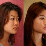 Rhinoplasty - Asian Before & After Patient #6394