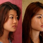 Rhinoplasty - Asian Before & After Patient #6394