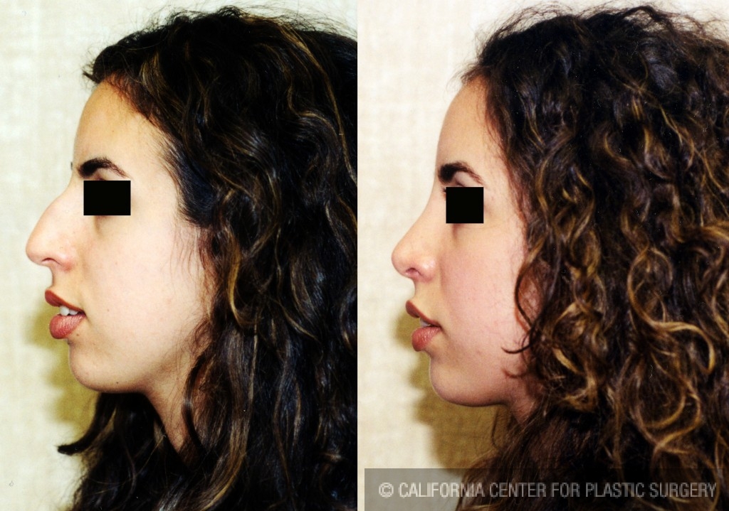 Rhinoplasty - Middle Eastern Before & After Patient #6325