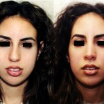 Rhinoplasty - Middle Eastern Before & After Patient #6325