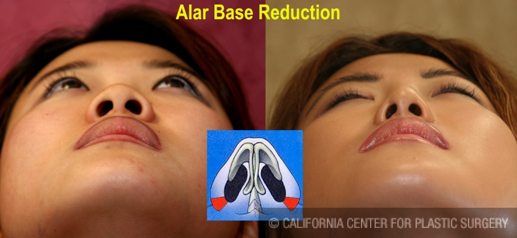 Rhinoplasty - Asian Before & After Patient #6394