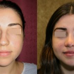 Rhinoplasty - Middle Eastern Before & After Patient #6339