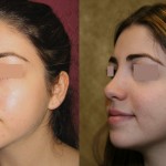 Rhinoplasty - Middle Eastern Before & After Patient #6339