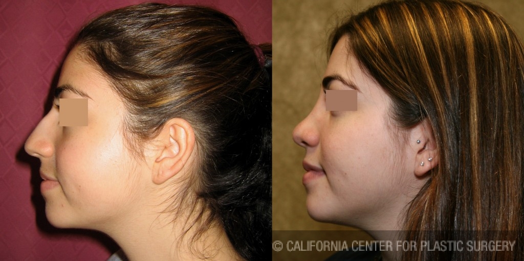 Rhinoplasty - Middle Eastern Before & After Patient #6339