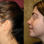 Rhinoplasty - Middle Eastern Before & After Patient #6339