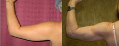 Liposuction Arms Before & After Patient #9464