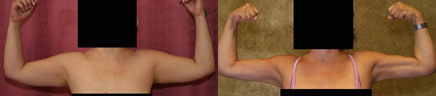 Liposuction Arms Before & After Patient #9479