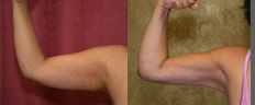 Liposuction Arms Before & After Patient #9479