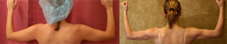 Liposuction Arms Before & After Patient #9484