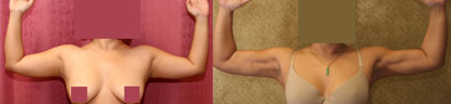 Liposuction Arms Before & After Patient #9489