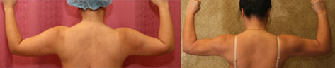 Liposuction Arms Before & After Patient #9489