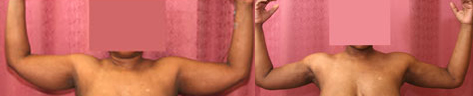 Liposuction Arms Before & After Patient #9492