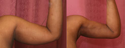 Liposuction Arms Before & After Patient #9492