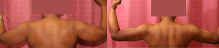 Liposuction Arms Before & After Patient #9492