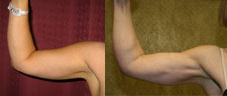 Liposuction Arms Before & After Patient #9464