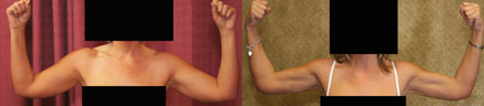 Liposuction Arms Before & After Patient #9471