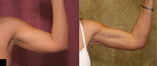 Liposuction Arms Before & After Patient #9471
