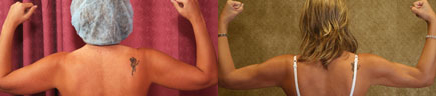 Liposuction Arms Before & After Patient #9471