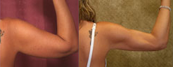 Liposuction Arms Before & After Patient #9471