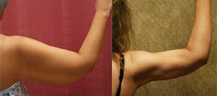 Liposuction Arms Before & After Patient #9476