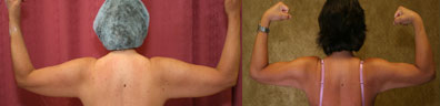 Liposuction Arms Before & After Patient #9479