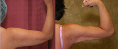 Liposuction Arms Before & After Patient #9479