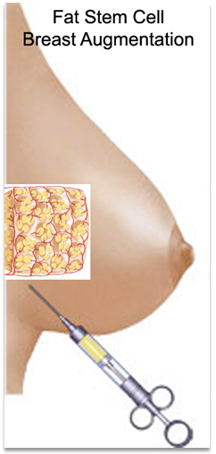Best Stem Cell Breast Augmentation Encino & Bakersfield
