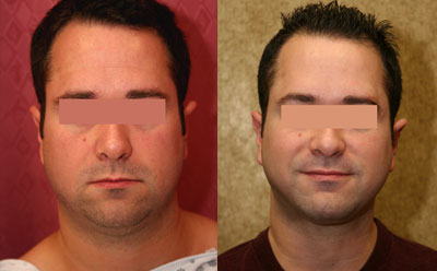 Male Neck & Face Liposuction Before & After Patient #9513