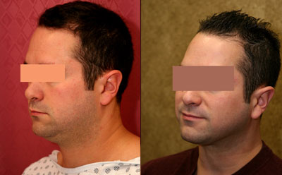 Male Neck & Face Liposuction Before & After Patient #9513