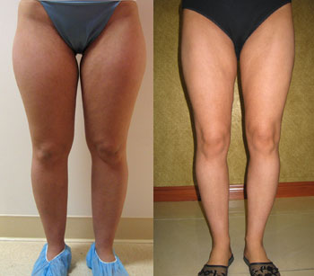 Liposuction Thighs Before & After Patient #9439