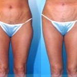 Liposuction Thighs Before & After Patient #9443
