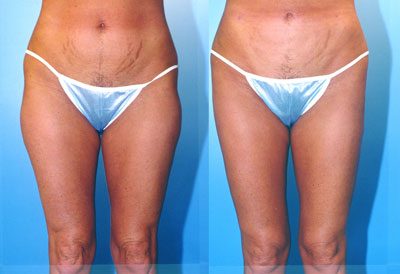 Liposuction Thighs Before & After Patient #9443