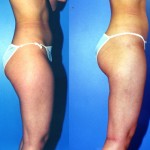 Liposuction Thighs Before & After Patient #9443