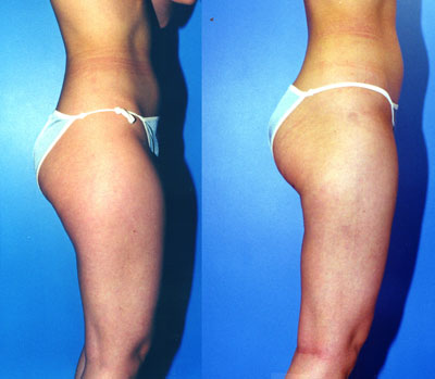 Liposuction Thighs Before & After Patient #9443
