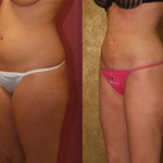 Liposuction Thighs Before & After Patient #9446