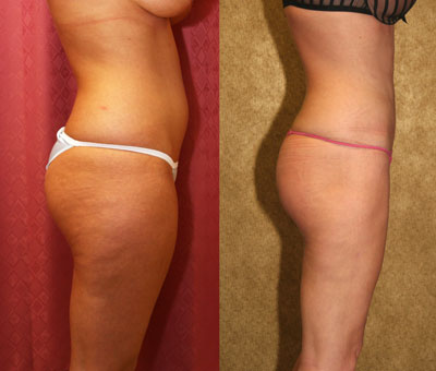 Liposuction Thighs Before & After Patient #9446