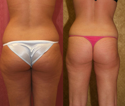 Liposuction Thighs Before & After Patient #9446